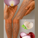 Remedios Caseros para las Várices con Cebolla, Ajo y Vinagre de Manzana Remedios Caseros para las Várices con Cebolla, Ajo y Vinagre de Manzana