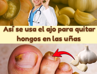 Cómo eliminar hongos de la piel, uñas, manos, pies y cuero cabelludo con ajo: el remedio natural más potente