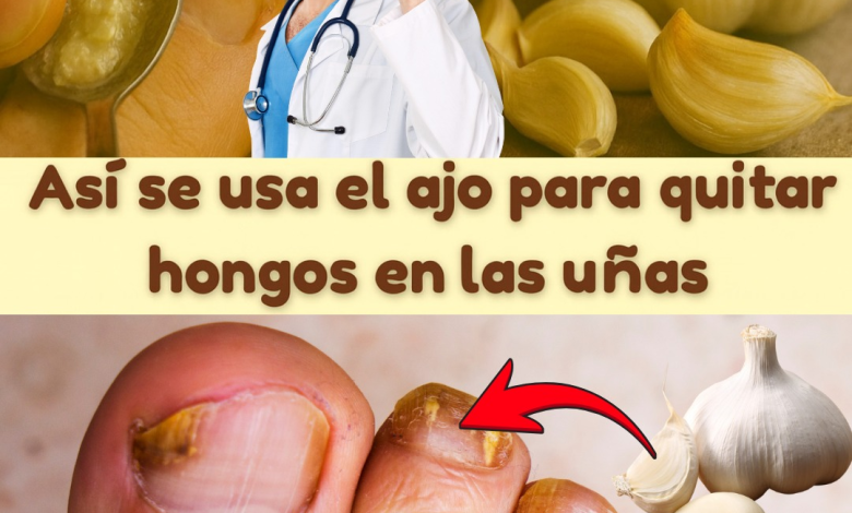 Cómo eliminar hongos de la piel, uñas, manos, pies y cuero cabelludo con ajo: el remedio natural más potente