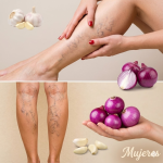 Remedios Caseros con Cebolla, Ajo y Vinagre de Manzana para Aliviar las Várices