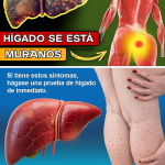 12 Signos Tempranos de Cirrosis Hepática que Nunca Debes Ignorar 12 Signos Tempranos de Cirrosis Hepática que Nunca Debes Ignorar