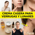 Crema Casera con Vinagre de Manzana, Bicarbonato y Árbol de Té para Verrugas y Lunares