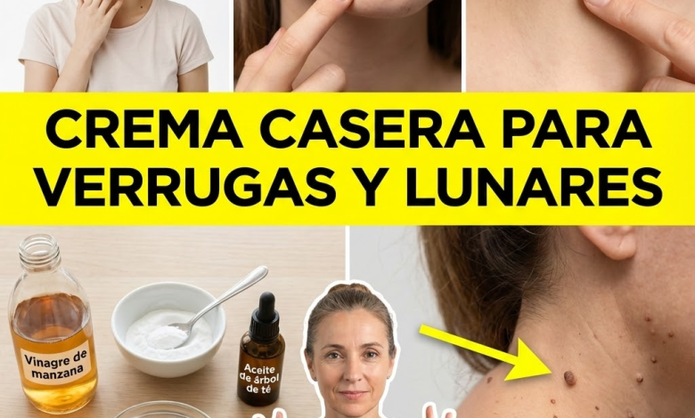 Crema Casera con Vinagre de Manzana, Bicarbonato y Árbol de Té para Verrugas y Lunares