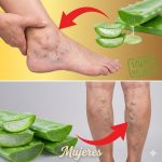 Aloe Vera para Piernas Hinchadas y Cansadas: El Remedio Natural que Tu Cuerpo Agradecerá