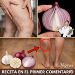 Remedios Caseros para Várices con Cebolla, Ajo y Vinagre de Manzana: Recetas, Uso Correcto y Precauciones (Guía clara) Remedios Caseros para Várices con Cebolla, Ajo y Vinagre de Manzana: Recetas, Uso Correcto y Precauciones (Guía clara)