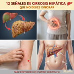 12 señales de cirrosis hepática que no debes ignorar