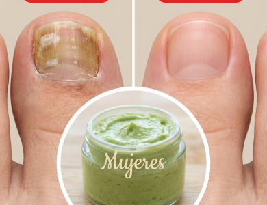 Remedios Naturales para los Hongos en los Pies y en las Uñas Remedios Naturales para los Hongos en los Pies y en las Uñas