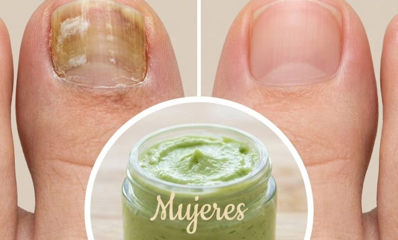 Remedios Naturales para los Hongos en los Pies y en las Uñas