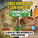 Uñas Sanas: Cómo Usar el Laurel para Combatir los Hongos (Onicomicosis)