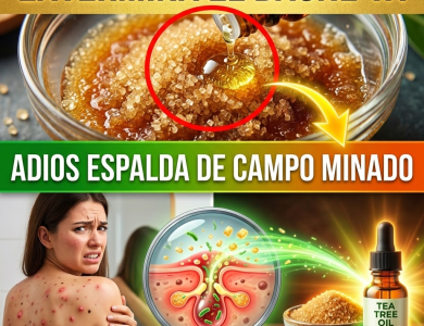 ¡¿Tienes la Espalda como “Campo Minado”?! Elimina el Bacné y las Manchas con el “Exterminador” Natural