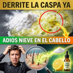 ¡Tu Champú Comercial Te Está Dejando Calva! El Remedio Definitivo Para Borrar la “Nieve” de tu Cabello